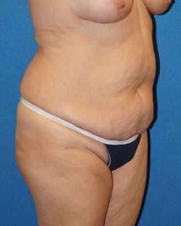 Tummy Tuck