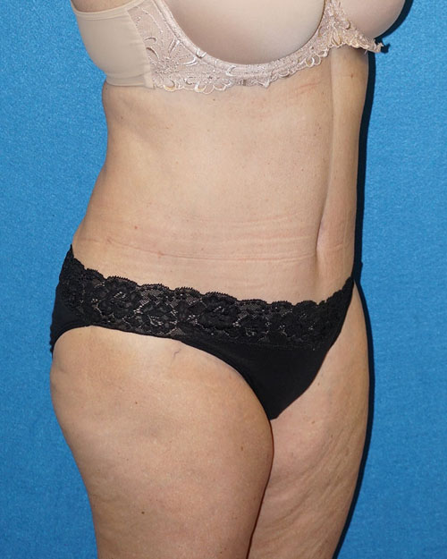 Tummy Tuck