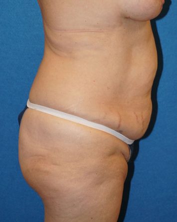 Tummy Tuck