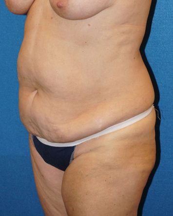 Tummy Tuck