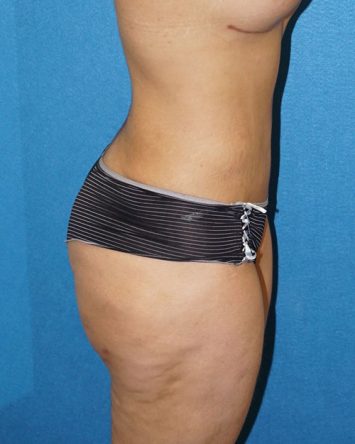 Tummy Tuck