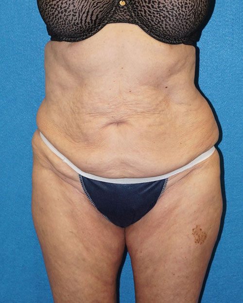 Tummy Tuck