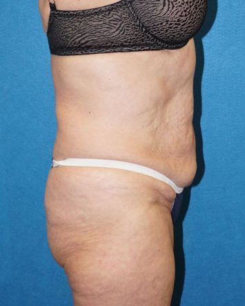 Tummy Tuck