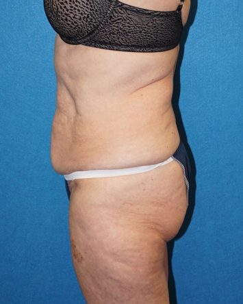 Tummy Tuck