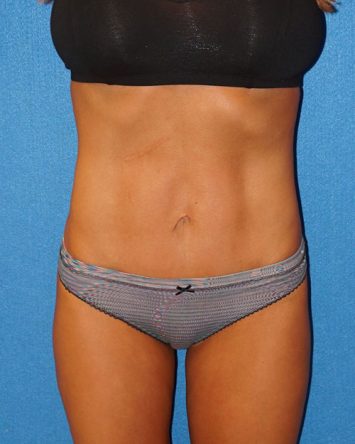 Tummy Tuck