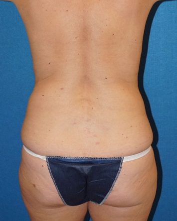 Tummy Tuck