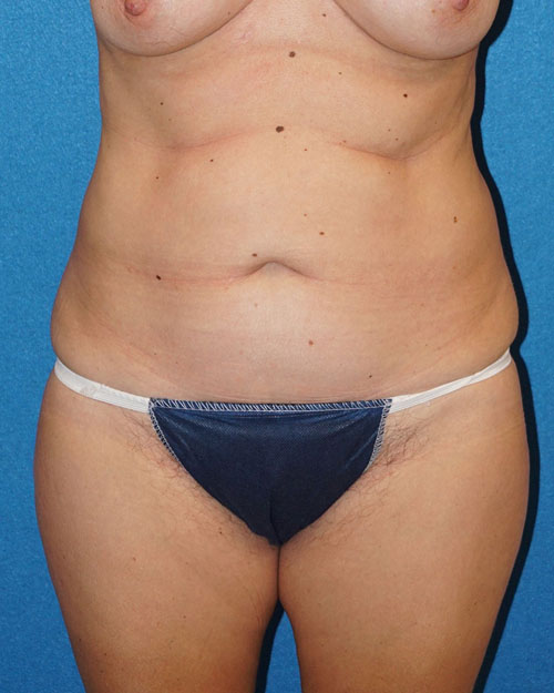 Tummy Tuck