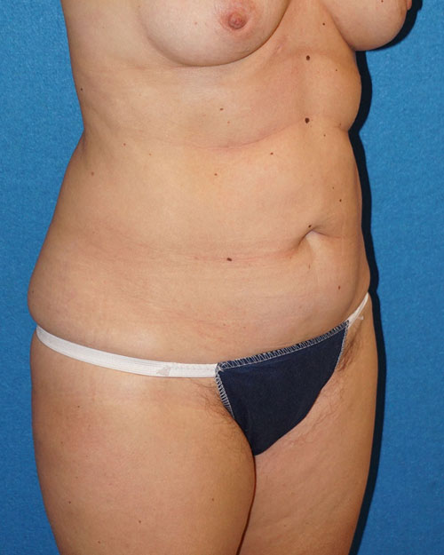 Tummy Tuck