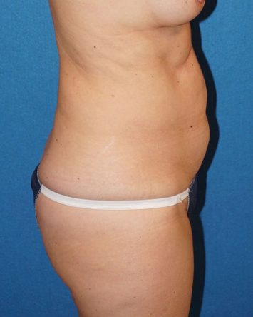 Tummy Tuck