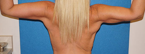 Brachioplasty