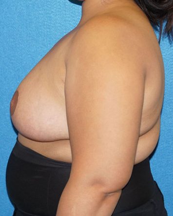 Breast Reduction