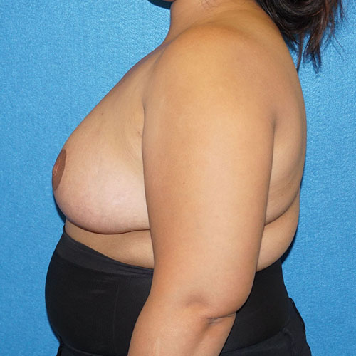 Breast Reduction