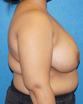 Breast Reduction