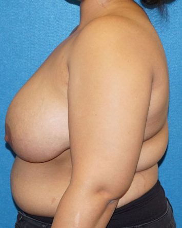 Breast Reduction