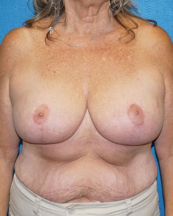 Breast Reduction