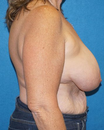 Breast Reduction