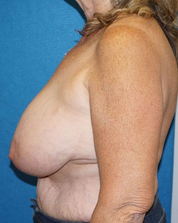 Breast Reduction