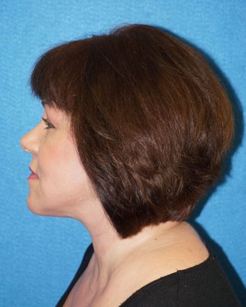 Facelift/Necklift