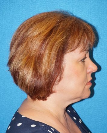 Facelift/Necklift