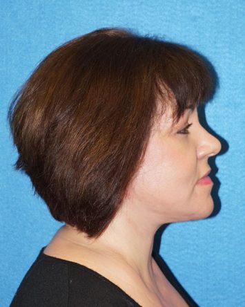 Facelift/Necklift