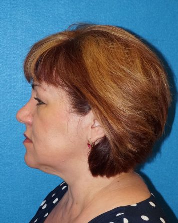 Facelift/Necklift