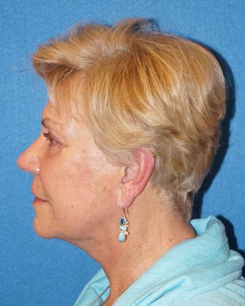 Facelift/Necklift