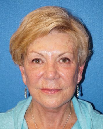 Facelift/Necklift