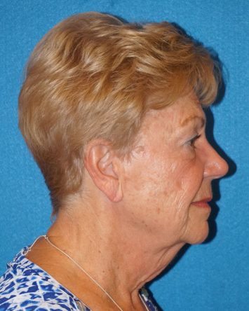 Facelift/Necklift