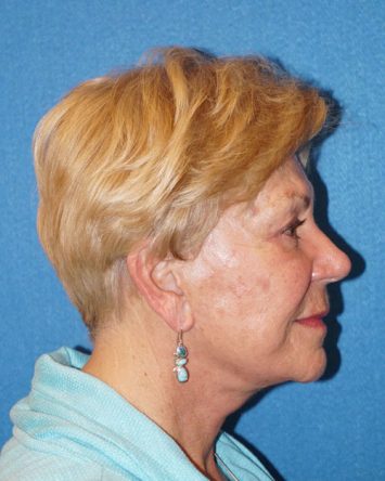 Facelift/Necklift