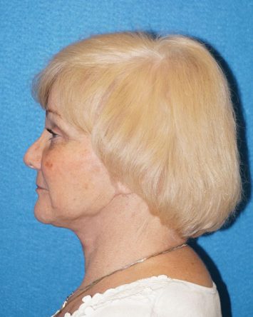 Facelift/Necklift