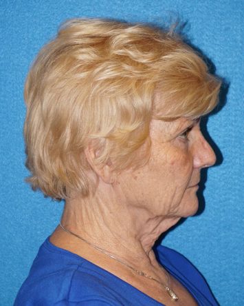 Facelift/Necklift