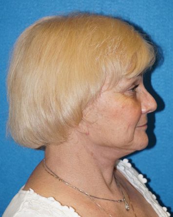 Facelift/Necklift