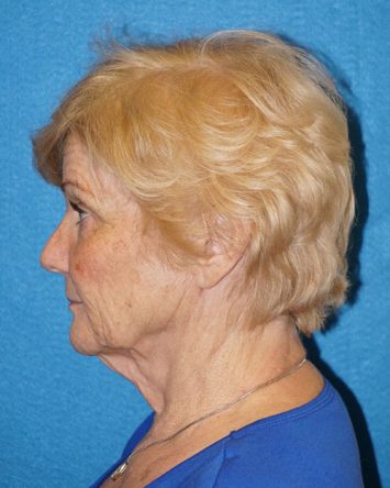 Facelift/Necklift