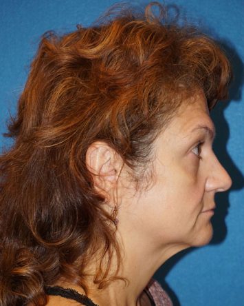 Facelift/Necklift