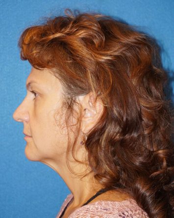 Facelift/Necklift