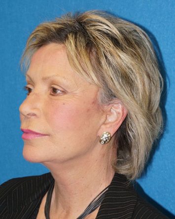 Facelift/Necklift