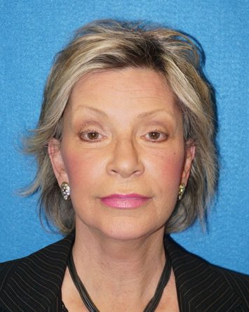 Facelift/Necklift