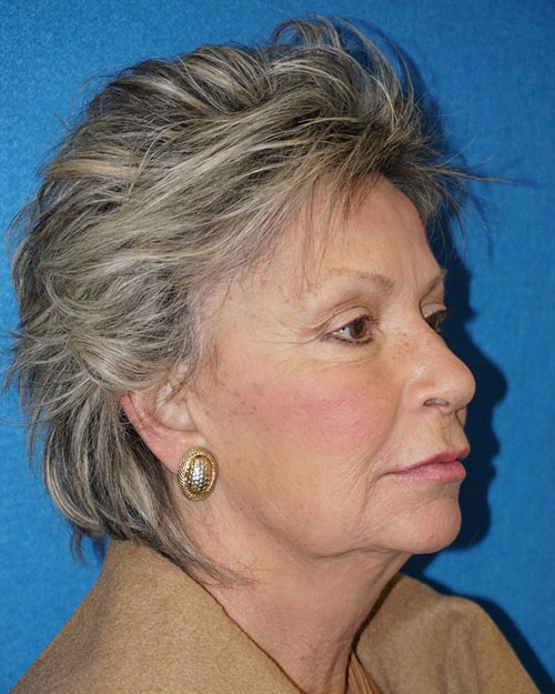 Facelift/Necklift