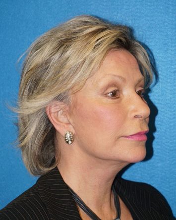 Facelift/Necklift