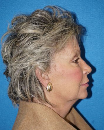 Facelift/Necklift