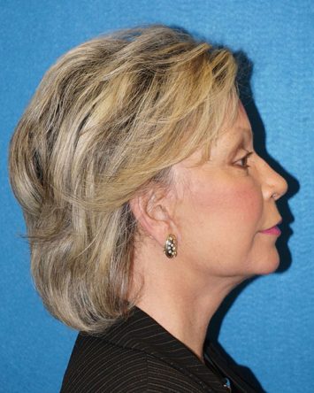 Facelift/Necklift