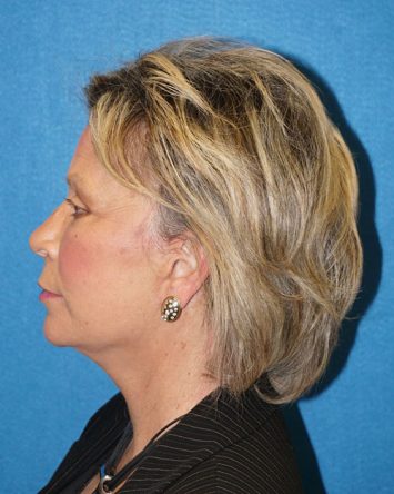 Facelift/Necklift