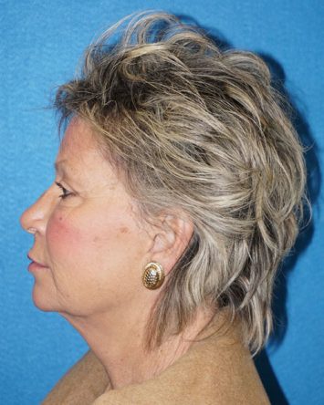 Facelift/Necklift