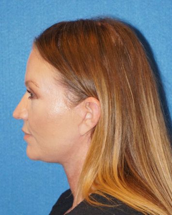 Facelift/Necklift