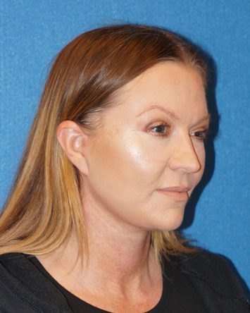 Facelift/Necklift