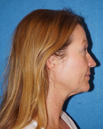 Facelift/Necklift