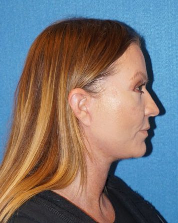 Facelift/Necklift