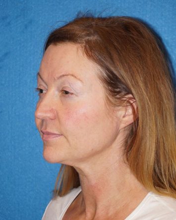 Facelift/Necklift