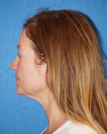 Facelift/Necklift