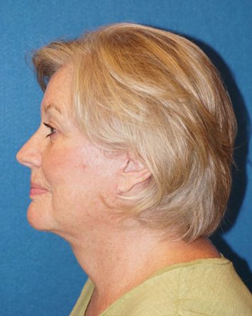 Facelift/Necklift